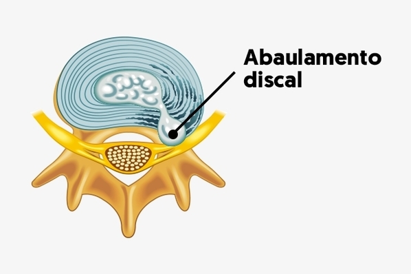 Abaulamento Discal O Que Quais Os Sintomas E Como Tratar M Dico Responde